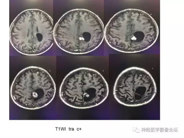 【病例】左顶叶部非典型囊性脑膜瘤1例影像讨论