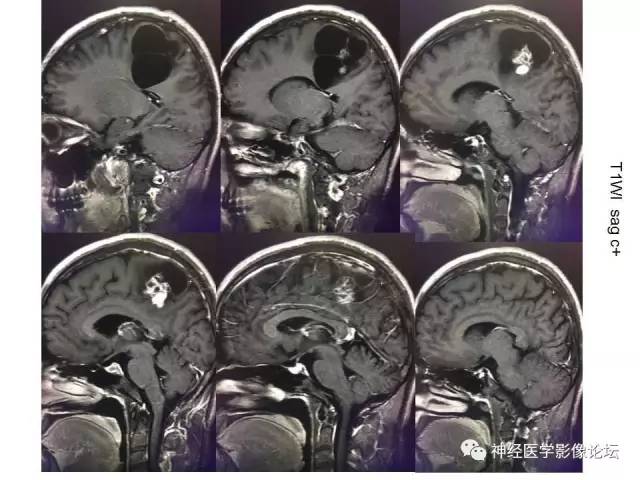 【病例】左顶叶部非典型囊性脑膜瘤1例影像讨论