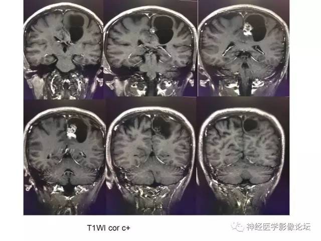 【病例】左顶叶部非典型囊性脑膜瘤1例影像讨论
