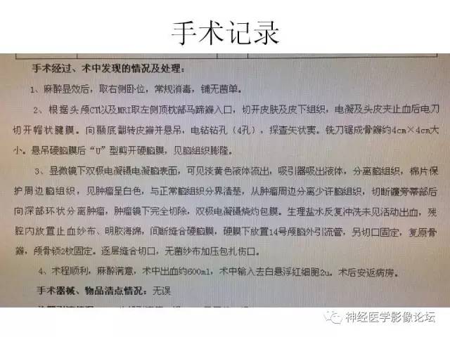 【病例】左顶叶部非典型囊性脑膜瘤1例影像讨论
