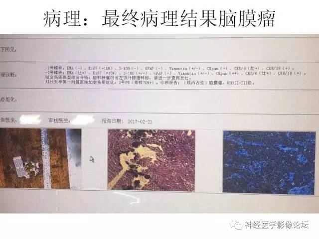 【病例】左顶叶部非典型囊性脑膜瘤1例影像讨论