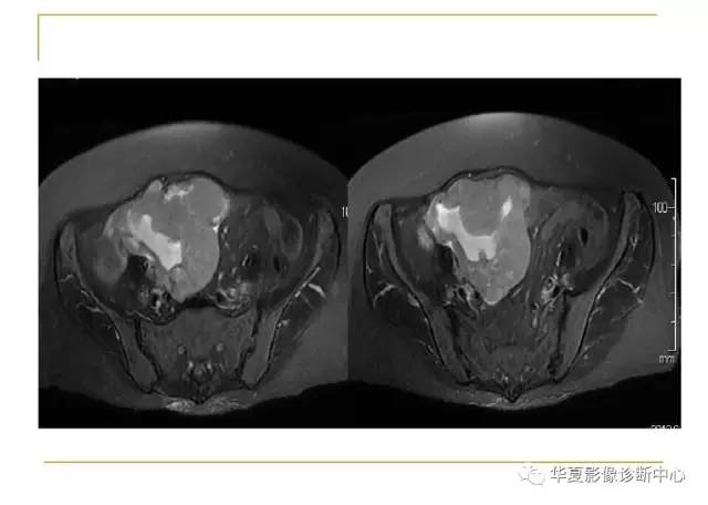 【病例】小肠间质瘤1例MR影像表现