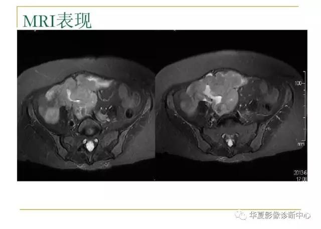 【病例】小肠间质瘤1例MR影像表现