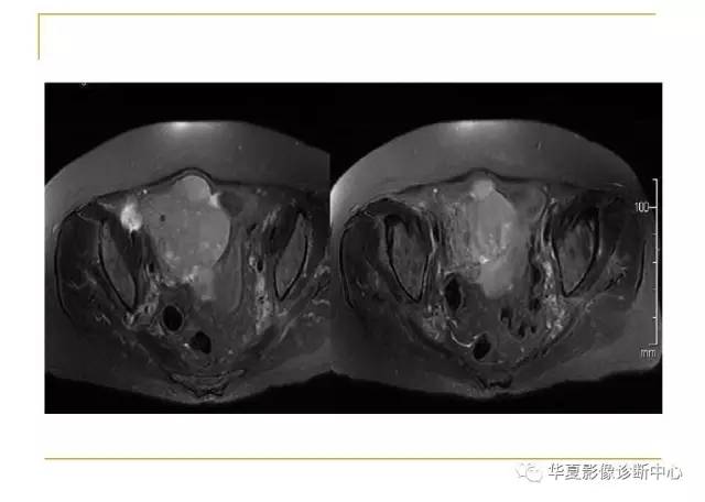 【病例】小肠间质瘤1例MR影像表现