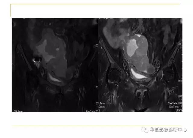 【病例】小肠间质瘤1例MR影像表现