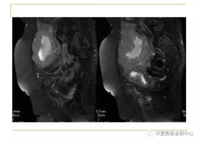 【病例】小肠间质瘤1例MR影像表现