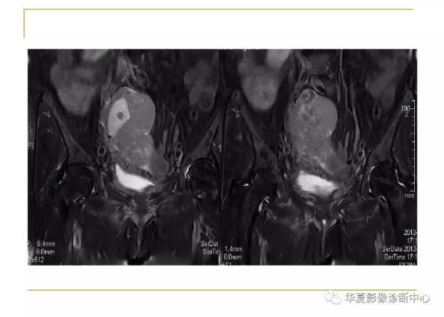 【病例】小肠间质瘤1例MR影像表现