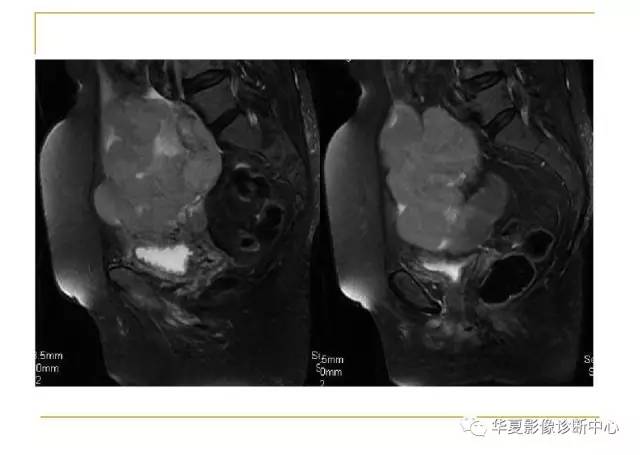 【病例】小肠间质瘤1例MR影像表现