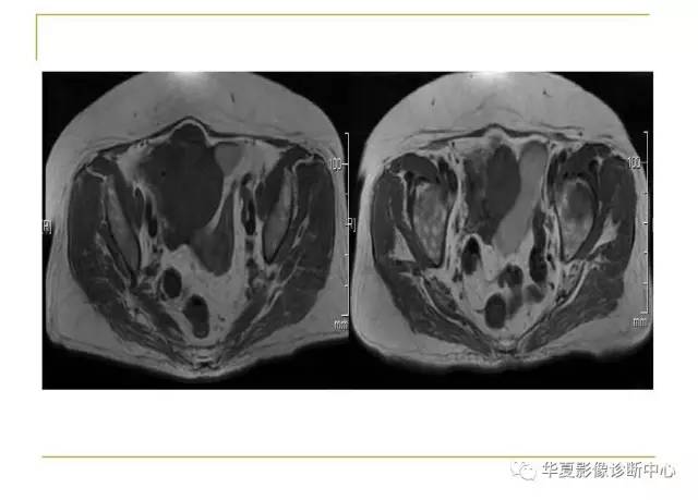 【病例】小肠间质瘤1例MR影像表现