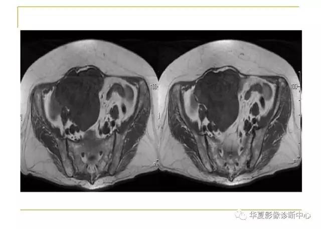 【病例】小肠间质瘤1例MR影像表现