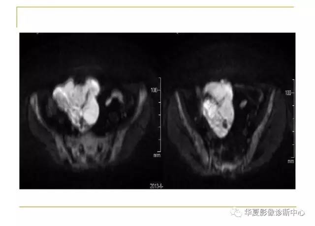 【病例】小肠间质瘤1例MR影像表现