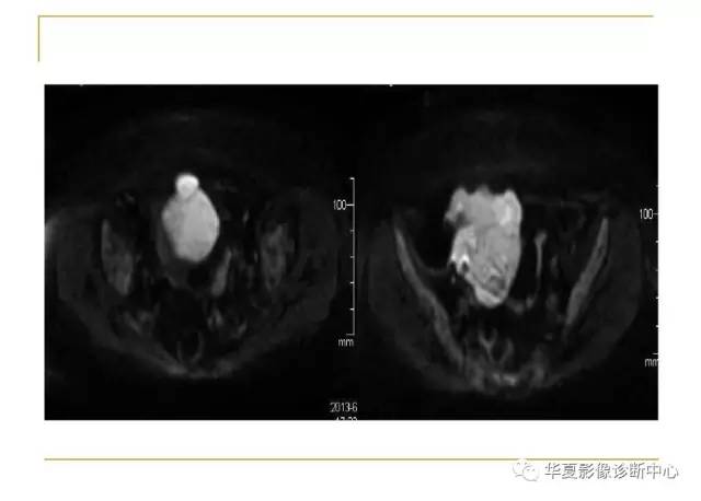 【病例】小肠间质瘤1例MR影像表现