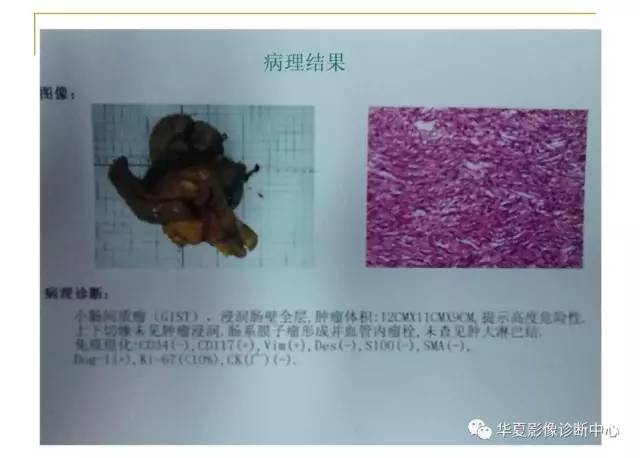 【病例】小肠间质瘤1例MR影像表现