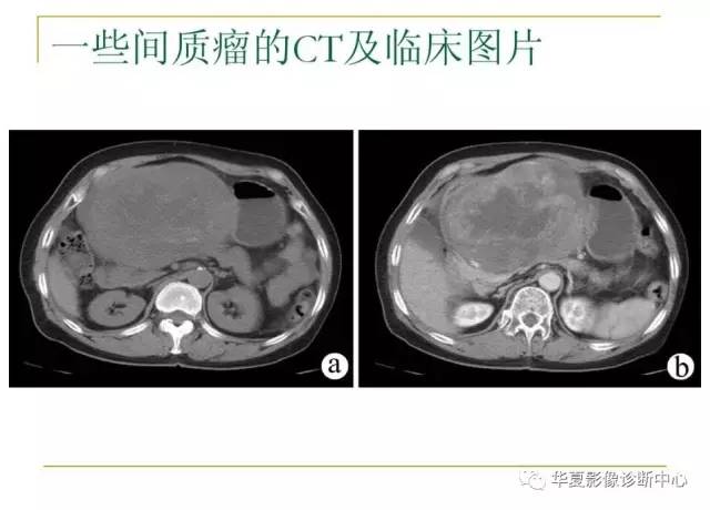 【病例】小肠间质瘤1例MR影像表现