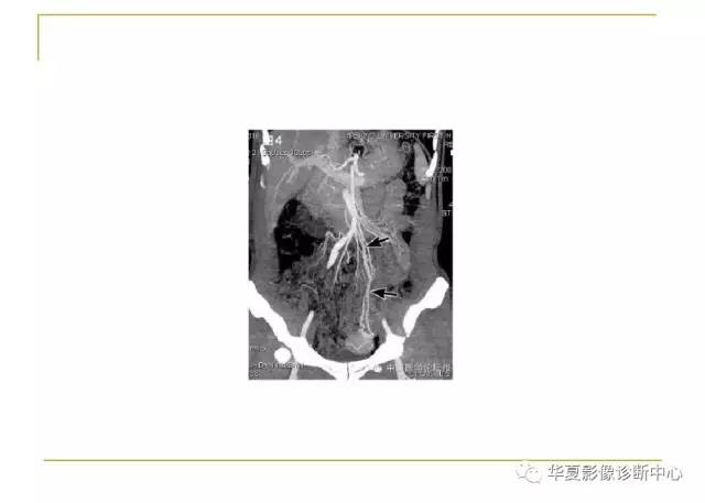 【病例】小肠间质瘤1例MR影像表现