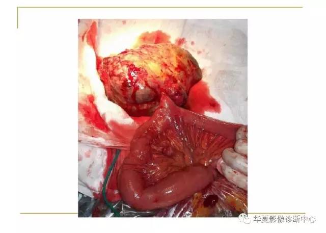 【病例】小肠间质瘤1例MR影像表现
