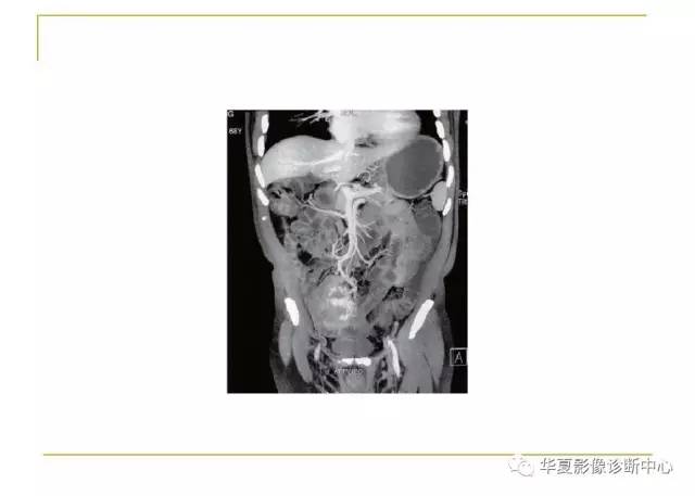 【病例】小肠间质瘤1例MR影像表现