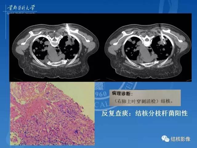 【PPT】肺肉芽肿病变的影像表现和病理基础