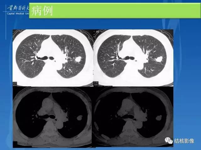 【PPT】肺肉芽肿病变的影像表现和病理基础