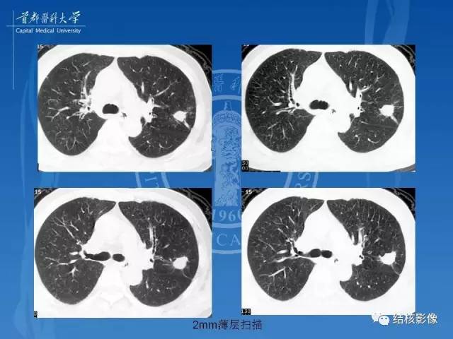 【PPT】肺肉芽肿病变的影像表现和病理基础