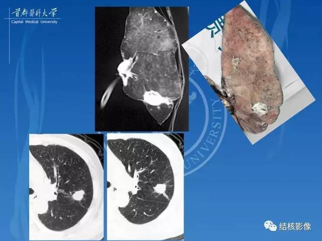 【PPT】肺肉芽肿病变的影像表现和病理基础