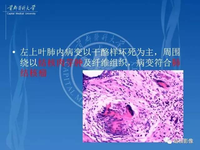 【PPT】肺肉芽肿病变的影像表现和病理基础