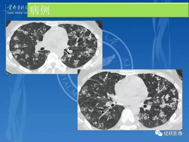 【PPT】肺肉芽肿病变的影像表现和病理基础