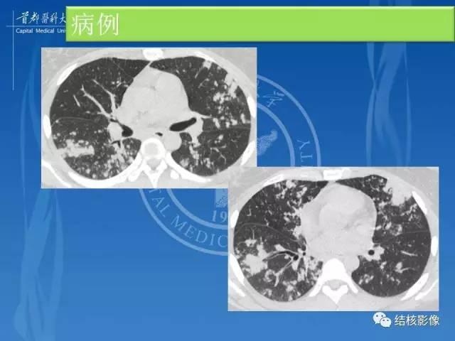 【PPT】肺肉芽肿病变的影像表现和病理基础