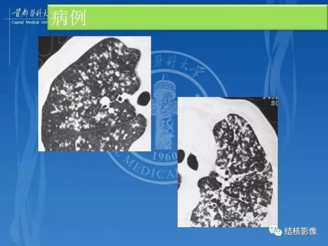 【PPT】肺肉芽肿病变的影像表现和病理基础