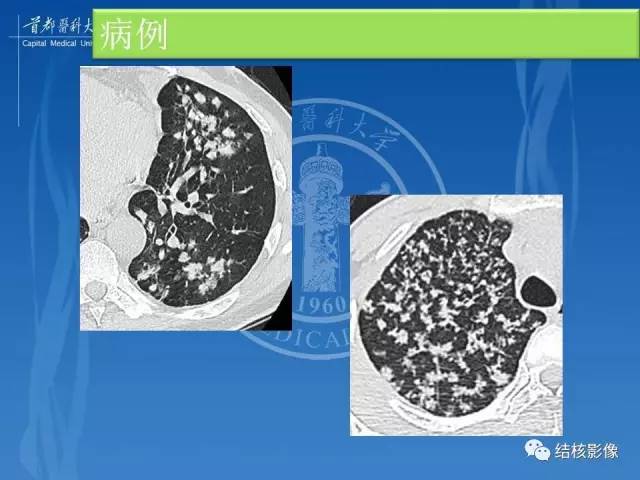 【PPT】肺肉芽肿病变的影像表现和病理基础