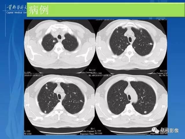 【PPT】肺肉芽肿病变的影像表现和病理基础