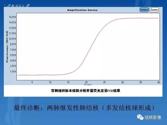 【PPT】肺肉芽肿病变的影像表现和病理基础