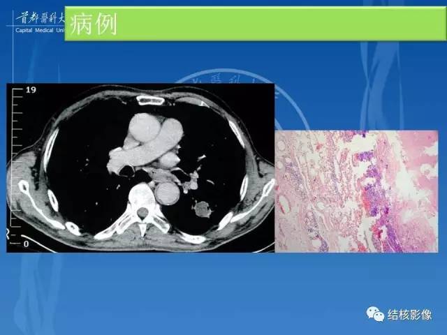 【PPT】肺肉芽肿病变的影像表现和病理基础