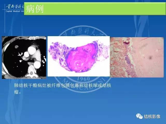 【PPT】肺肉芽肿病变的影像表现和病理基础