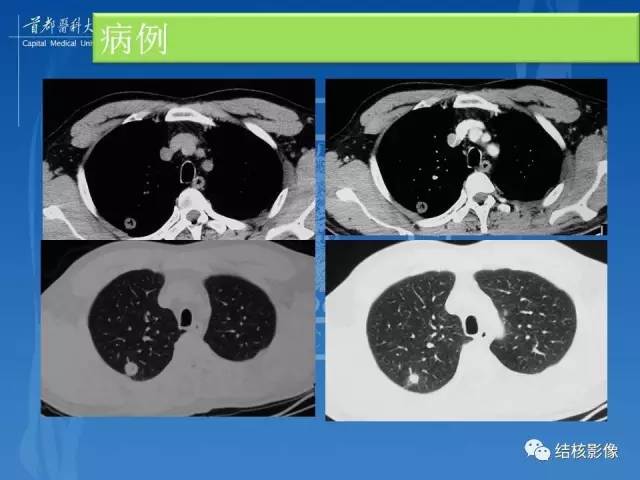 【PPT】肺肉芽肿病变的影像表现和病理基础