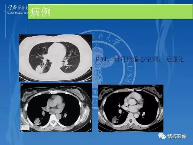 【PPT】肺肉芽肿病变的影像表现和病理基础