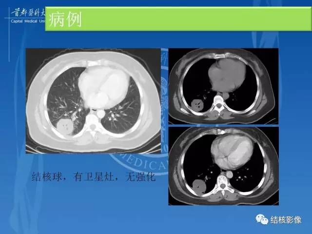 【PPT】肺肉芽肿病变的影像表现和病理基础