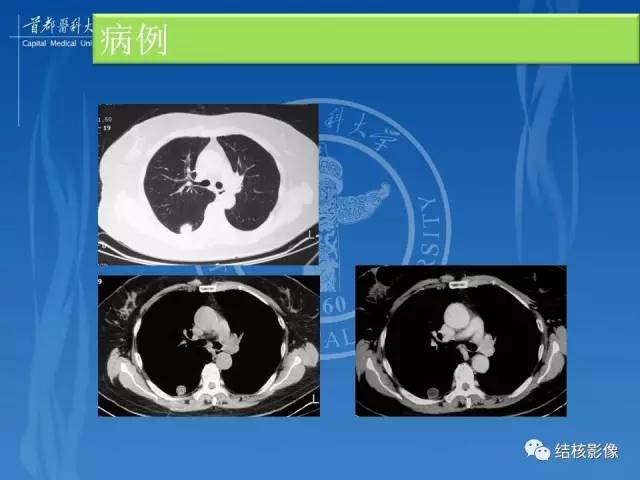 【PPT】肺肉芽肿病变的影像表现和病理基础