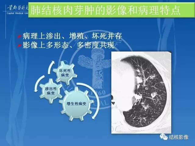 【PPT】肺肉芽肿病变的影像表现和病理基础