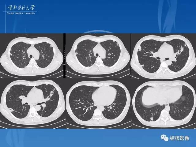 【PPT】肺肉芽肿病变的影像表现和病理基础