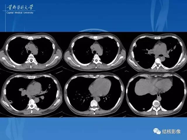 【PPT】肺肉芽肿病变的影像表现和病理基础