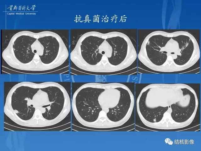 【PPT】肺肉芽肿病变的影像表现和病理基础