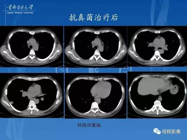 【PPT】肺肉芽肿病变的影像表现和病理基础