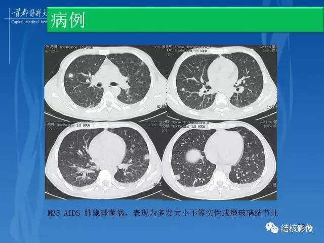 【PPT】肺肉芽肿病变的影像表现和病理基础