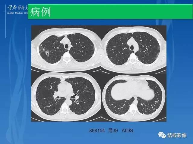 【PPT】肺肉芽肿病变的影像表现和病理基础