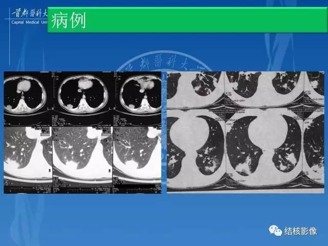 【PPT】肺肉芽肿病变的影像表现和病理基础