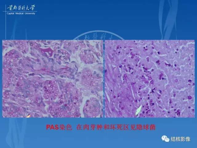 【PPT】肺肉芽肿病变的影像表现和病理基础