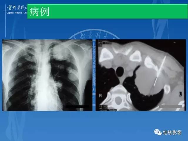 【PPT】肺肉芽肿病变的影像表现和病理基础