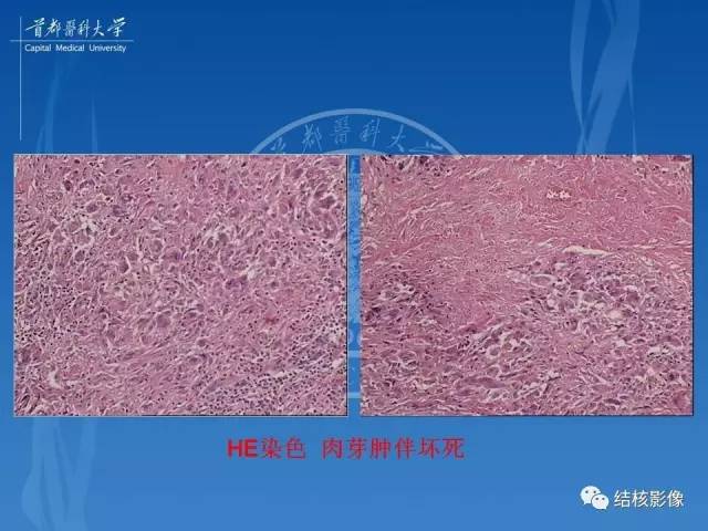 【PPT】肺肉芽肿病变的影像表现和病理基础