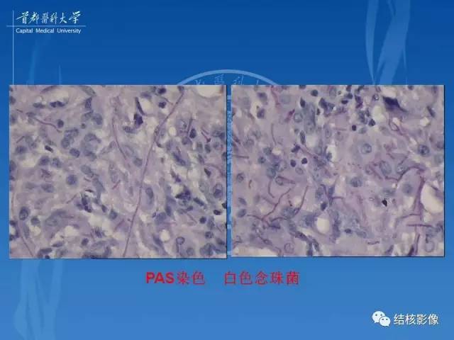 【PPT】肺肉芽肿病变的影像表现和病理基础